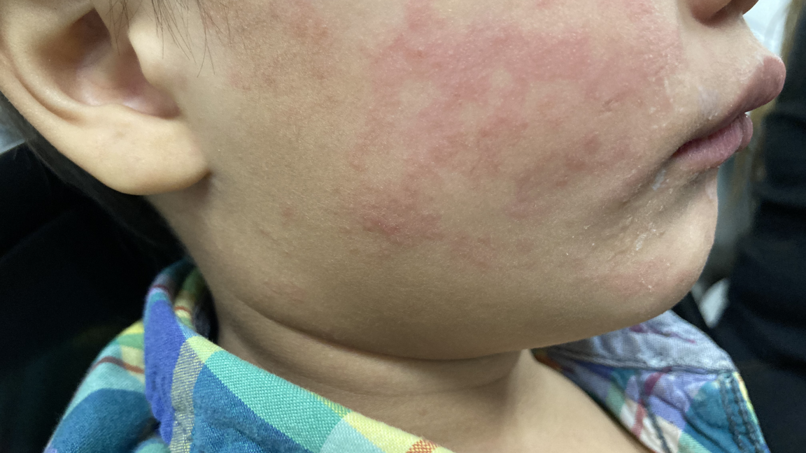Measles continues raging in South Carolina; 99 new cases since Tuesday